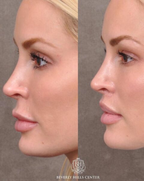 Kobieta w blond włosach i z długimi rzęsami prezentuje efekt po zabiegu lip lift.
