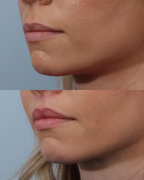 Zdjęcia kobiety: na górze przed zabiegiem lip lift, a pod spodem zdjęcie po zabiegu z powiększoną górną wargą.