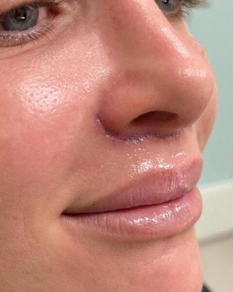 Zdjęcia kobiety po zabiegu lip lift i zbliżenie na jej bliznę pod nosem.