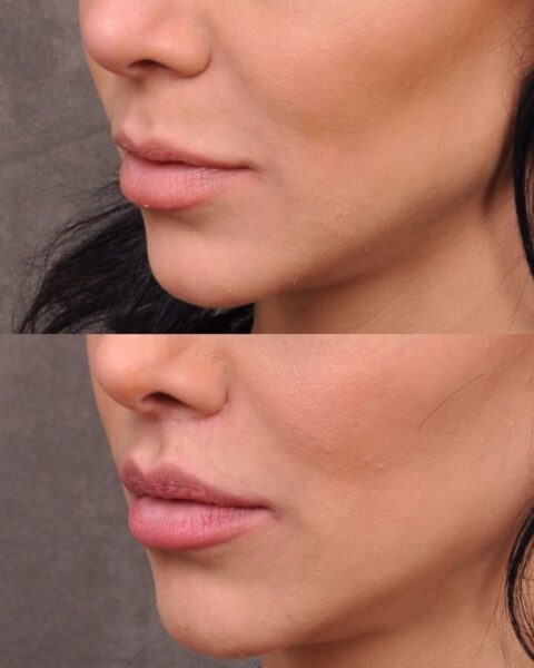 Zdjęcia porównujące usta tej samej kobiety przed i po zabiegu lip lift. Na górze przed uniesieniem wargi, a na dole efekt po uniesieniu wargi.