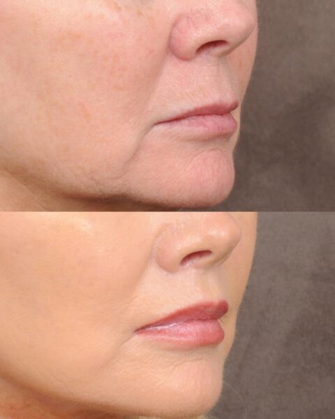 Zdjęcia porównujące usta dojrzałej kobiety przed i po zabiegu lip lift. Na górze przed uniesieniem wargi, a na dole efekt po uniesieniu wargi.
