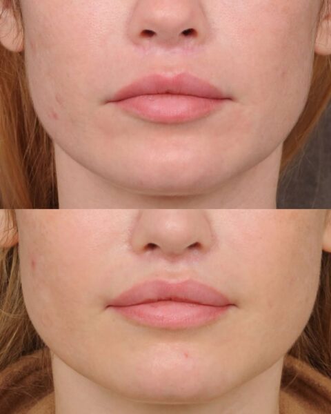 Zdjęcia młodej kobiety porównujące jej wygląd przed zabiegiem lip lift oraz po zabiegu. Wyraźnie widać powiększenie ust.