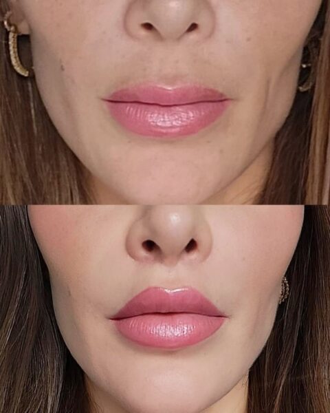 Dwa zdjęcia porównujące wygląd kobiety przed zabiegiem lip lift oraz zdjęcie po zabiegu. Usta są wyraźnie większe. Zdjęcia ustawione są jedne pod drugim.
