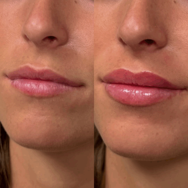 Zdjęcie przedstawiające efekt po zabiegu lip lift. Po lewej są małe usta przed, a po prawej pełne usta po zabiegu z błyszczykiem na wargach.