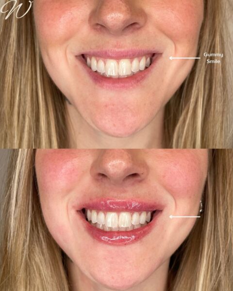 Zdjęcie przedstawiające usta tej samej kobiety przed powiększaniem ust. Na górze widać małe usta naturalne i z gummy smile. Na dole usta są powiększone metodą lip flip, a widoczność dziąseł jest mniejsza.
